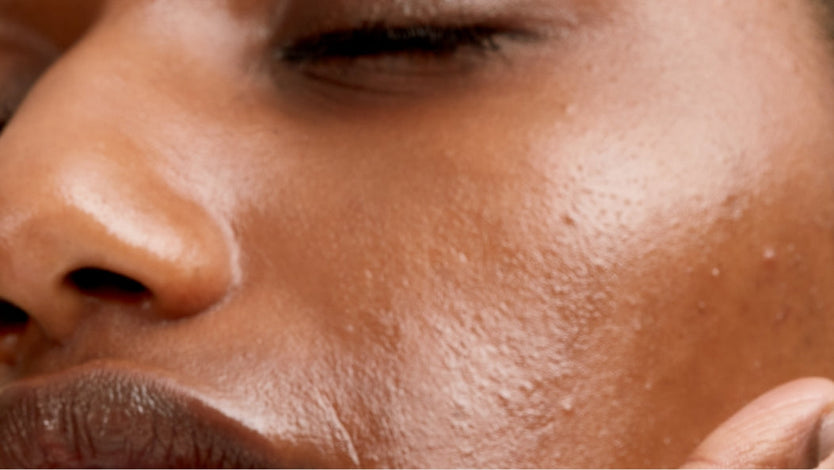 The best routine for acne-prone skin