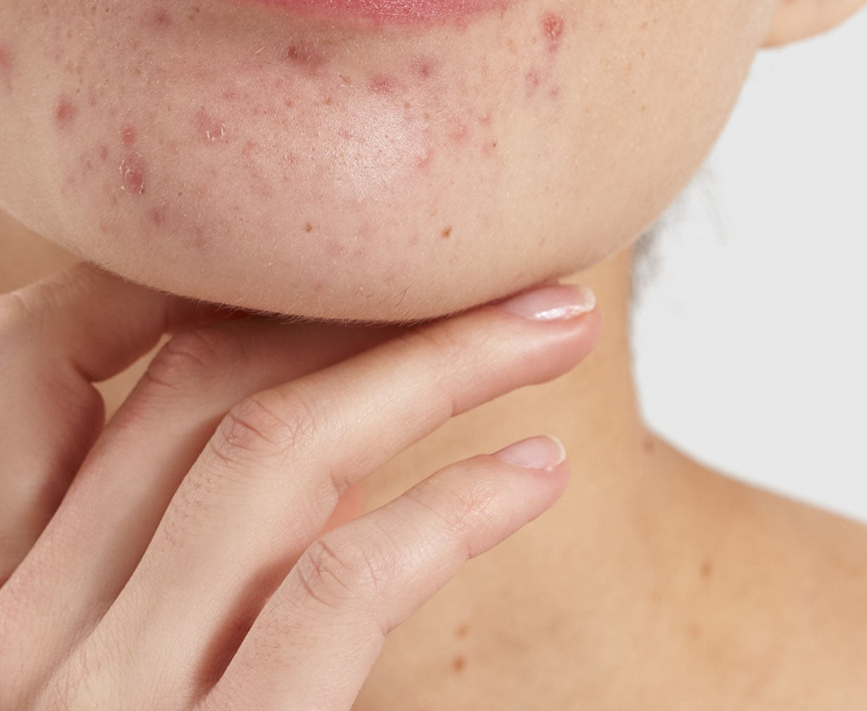  spot prone skin